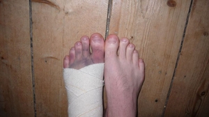 Broken Foot.